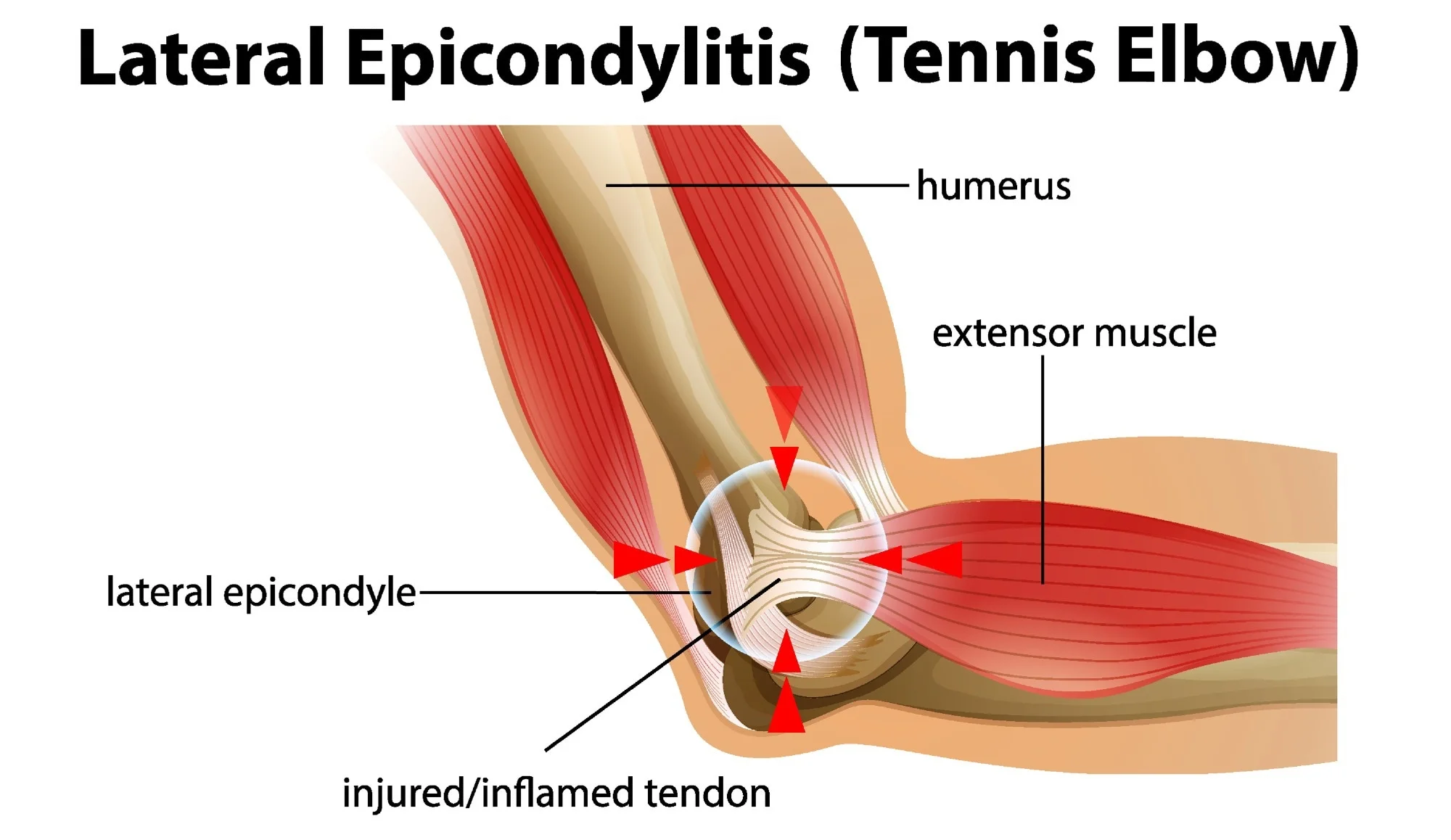 tennis elbow treatment malaysia