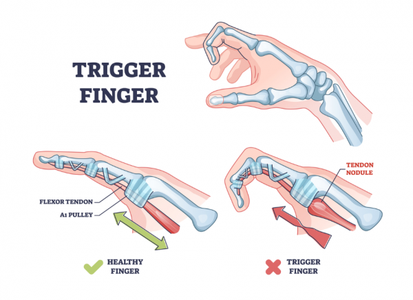 trigger finger treatment malaysia