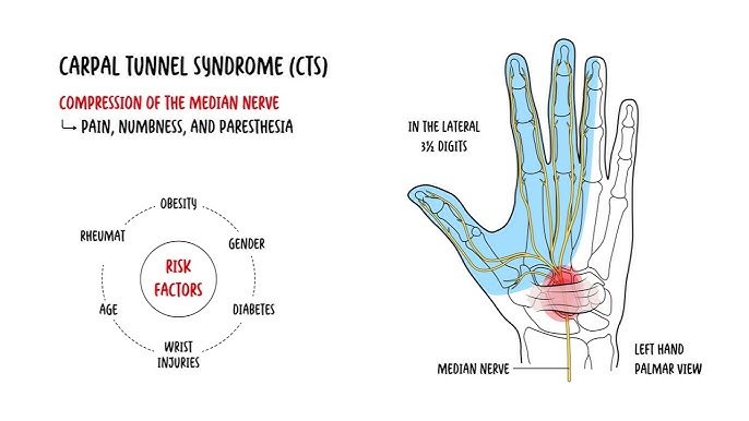 carpal tunnel syndrome treatment malaysia